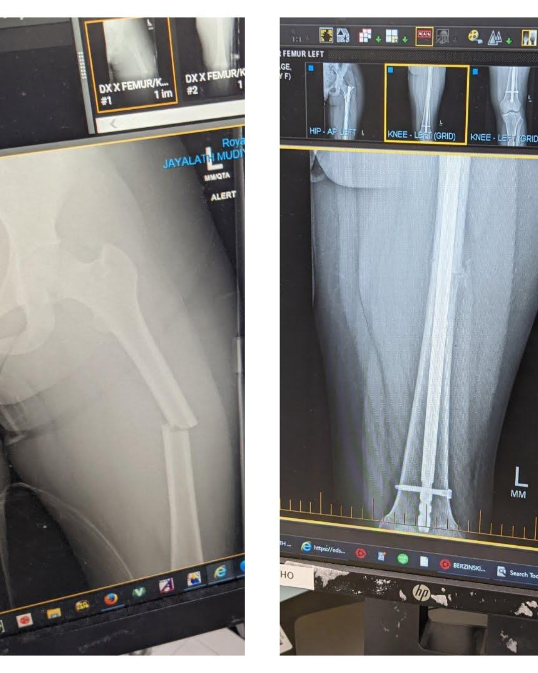 X-ray of left leg post injury